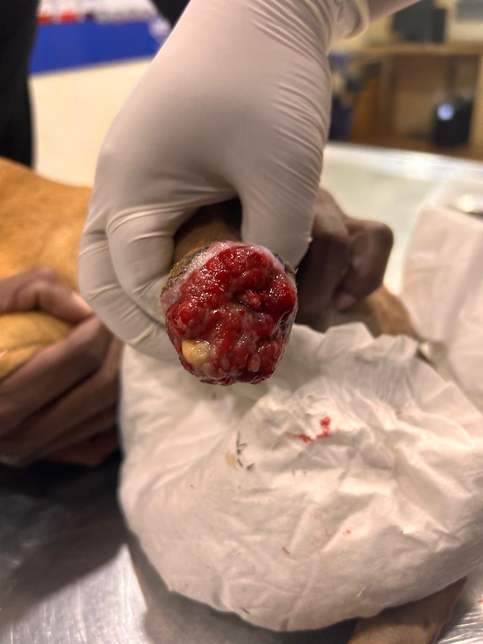 Hair Transplant Before